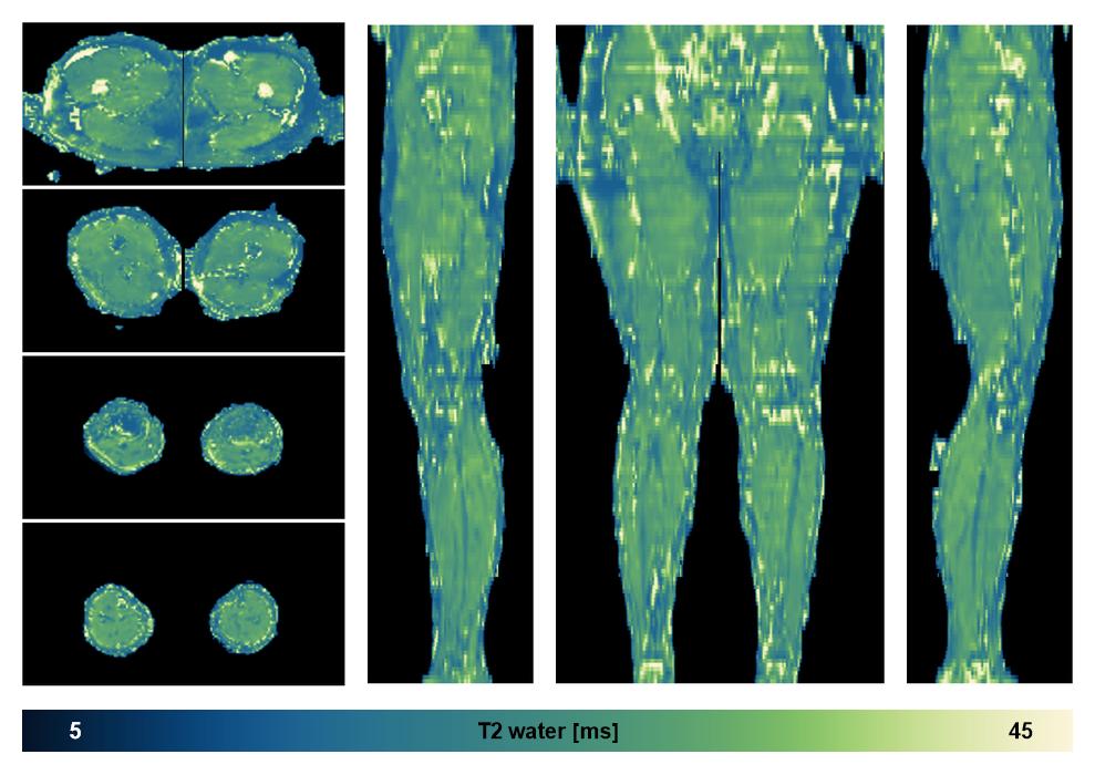 The water only T2 relaxation time of the lower extremity obtained from multi echo spin echo t2 mapping with EPG based reconstruction.